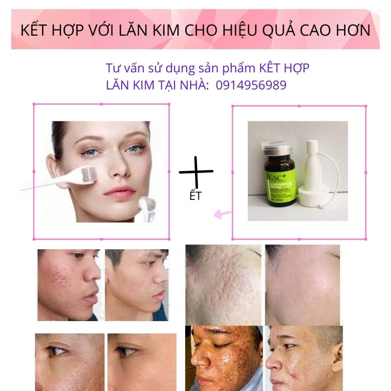 Tê Bào Gốc Chữa Sẹo Rỗ Lâu Năm Sẹo Mụn Sẹo Thủy Đậu Gsc Của Dr.acneal Kết Hợp Kim Lăn Hoặc Vikim