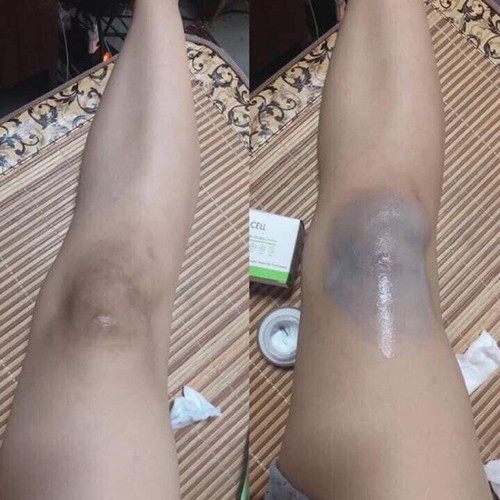 [HCM][H]  CHÍNH HÃNG kem trị thâm làm trắng vùng nách，khử mùi hôi vùng nách，trị thâm vùng kínđầu gốikhuỷu tay chân