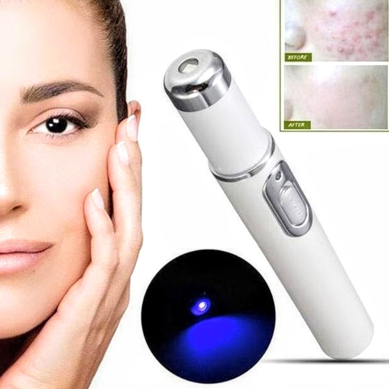 Siêu Giá Với Bộ Thiết Bị Xóa Mụn Sẹo Nết Nhăn Bằng Laser Ánh Sáng Xanh Nhỏ Gọn