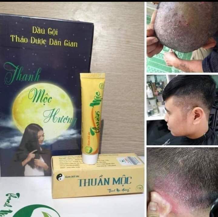 [HCM]COMBO DUYỆT NẤM DA ĐẦU