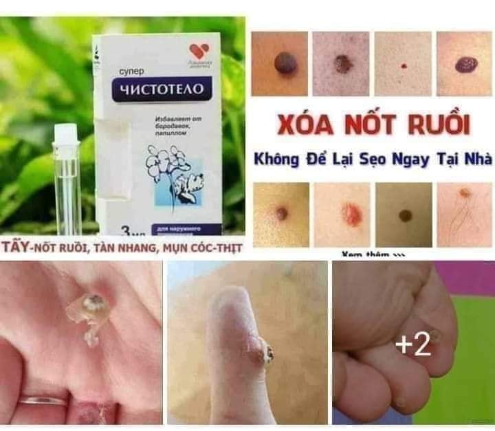 Gel tẩy nốt ruồi mụn cóc mụn thịt tàn nhang sẹo lồi Develinil của Nga - Tươi Shop