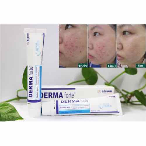[HCM]Gel Giảm Ngừa Mụn Derma Forte 15G