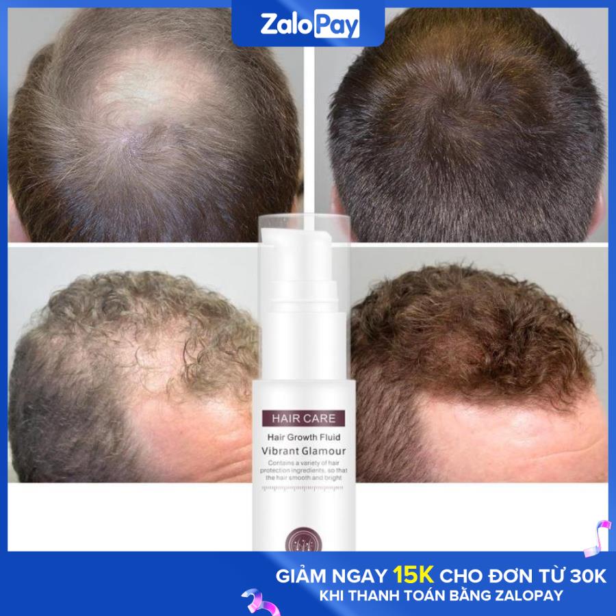 [Hcm]Tinh Chất Mọc Tóc Ngăn Ngừa Rụng Tóctinh Chất Tăng Trưởng Tóc Hair Grower Dầu Xả Tóc Tinh Chất Chống Rụng Tóc Cho Nam Và Nữ 30Ml