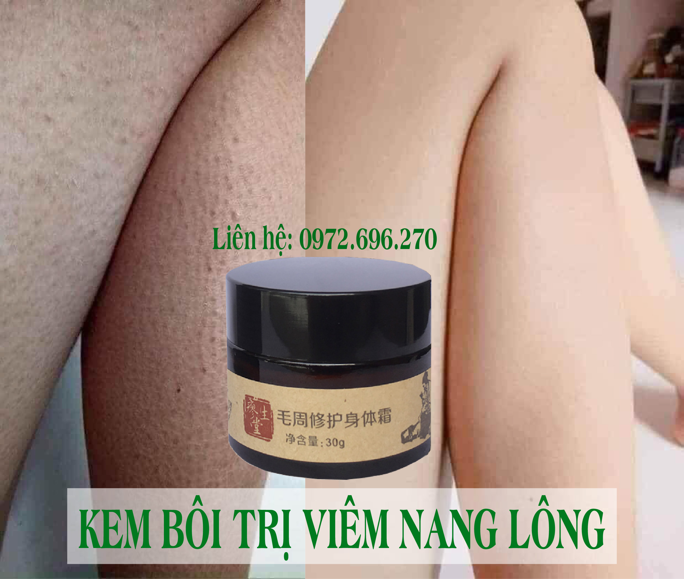 Kem Bôi Viêm Nang Lông - Viêm Lỗ Chân Lông [ Cực Hiệu Quả ]