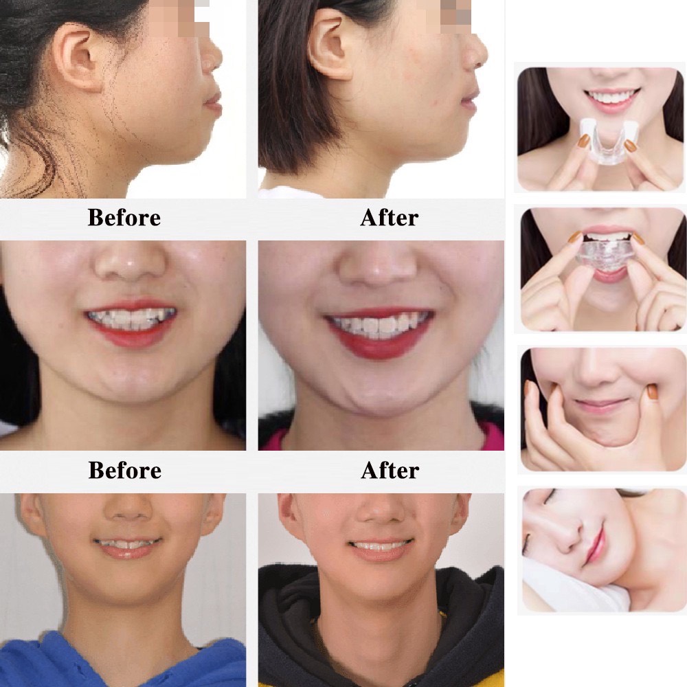 [HCM]BỘ NIỀNG RĂNG TẠI NHÀ CHO TRẺ EM – LẺ  [A3] – THẾ HỆ MỚI