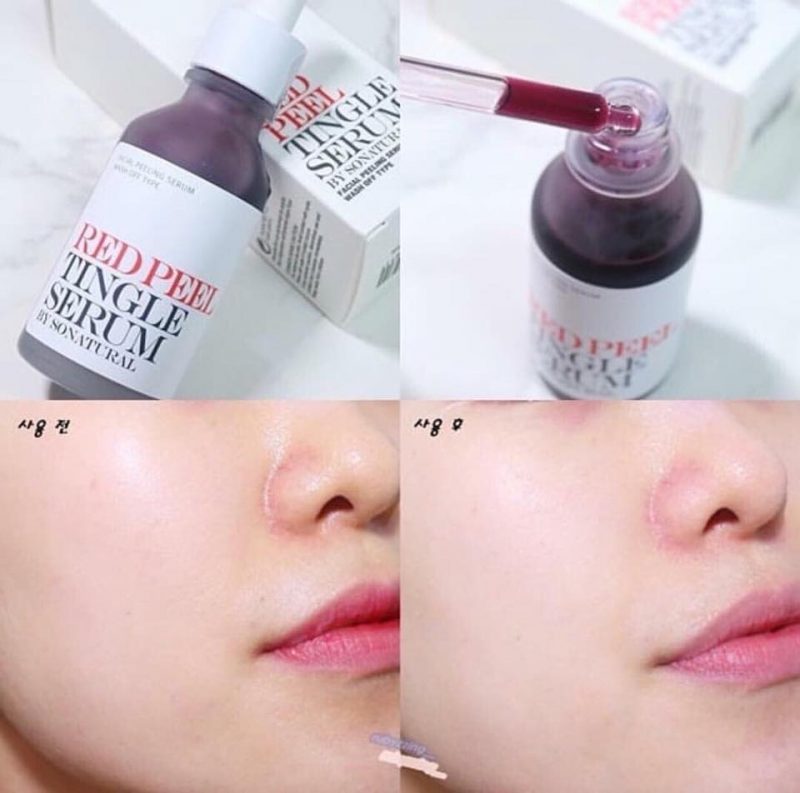Tinh Chất Thay Da Sinh Học So’Natural Red Peel Tingle Serum 35ml