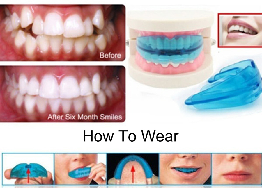 [ HÀNG CHUẨN LOẠI 1] DỤNG CỤ NIỀNG RĂNG TẠI NHÀ CAO CẤP