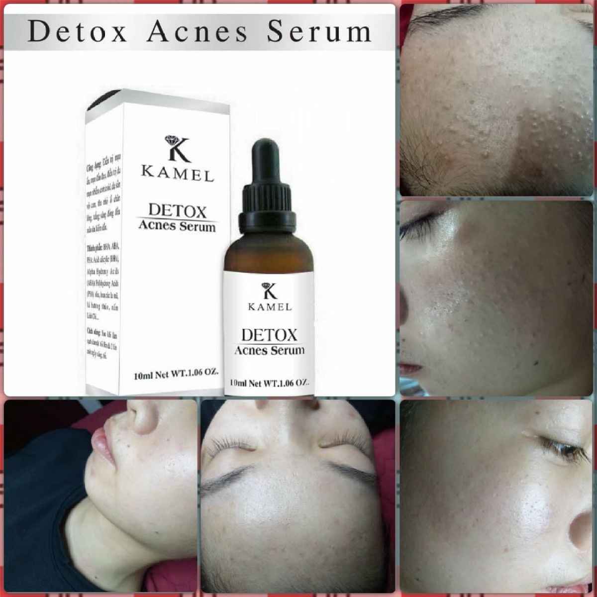 SERUM TRỊ MỤN KAMEL DETOX ACNES