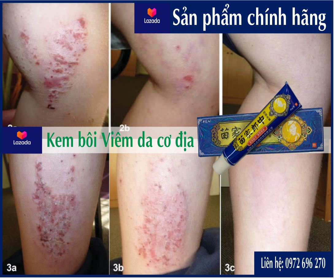 Kem Bôi Viêm Da Cơ Địa [ Cực Hiệu Quả ] Hết Sạch Viêm Da Chỉ Với 1 Liệu Trình