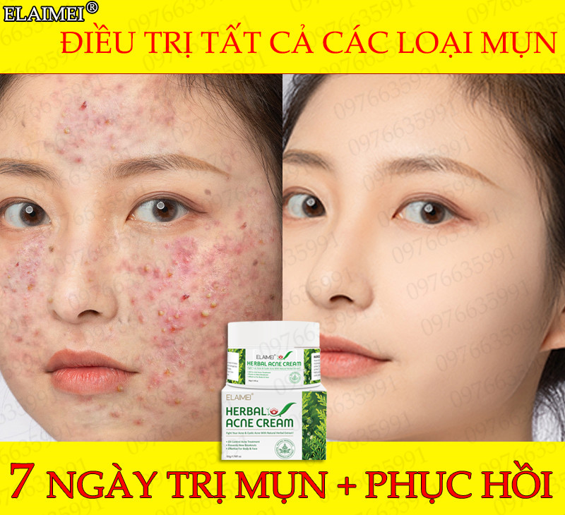 ?7 Ngày Trị Mụn Elaimei Kem Dưỡng Da 50G Điều Trị Mụn Trứng Cá Nhẹ Nhàng Nhanh Chóng Phục Hồi Các Vết Mụn Trên Mặt Giúp Da Mịn Màng Và Giảm Thâm(Kem Ngừa Mụn Giảm Mụn Giảm Thâm Trắng Da.làm Mịn Da)