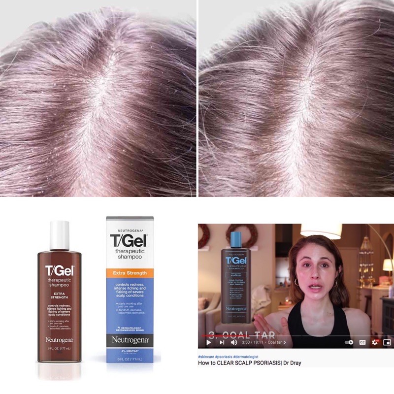 Dầu Gội TGel Neutrogena Hết Gàu Vảy Nến Hiệu Quả Neutrogena T/Gel Extra Strength Therapeutic Dandruff Shampoo (Hàng Mỹ)