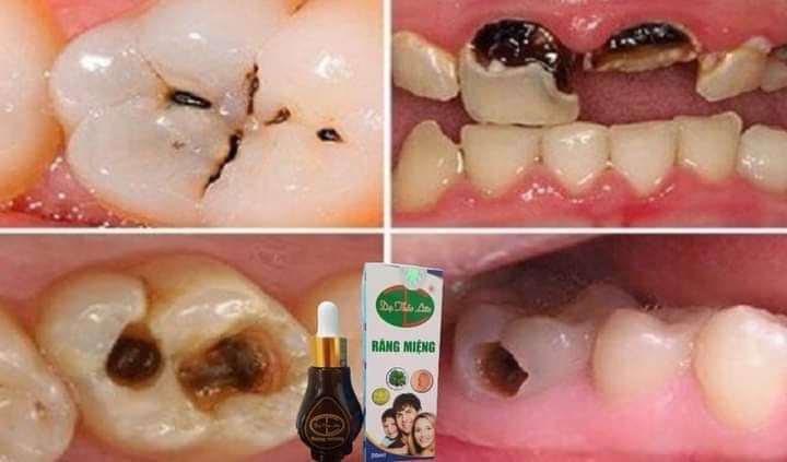 Tinh dầu răng miệng Dạ Thảo Liên