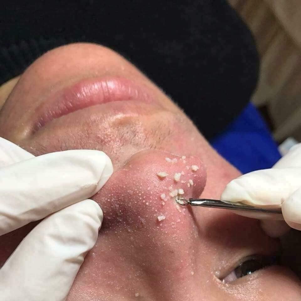 BỘ NẶN MỤN 4 CÂY