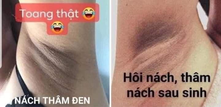 Kem Tri Thâm Nách Hôi Nách Bán Chạy Số 1