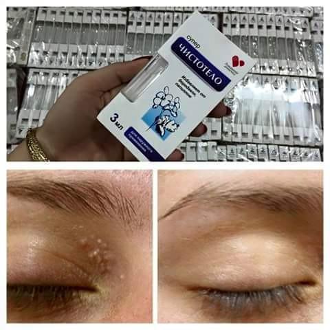 Gel tẩy nốt ruồi xóa mụn ruồi tại nhà Dvelinil nhập khẩu Nga giúp ngừa mụn ruồi tàn nhang mụn cóc mụn thịt sẹo lồi vừa và nhỏ triệt để bằng nước cất cộng Natri Hydrixit or kali hydroxit an toàn ít để lại sẹo dành cho người lớn.