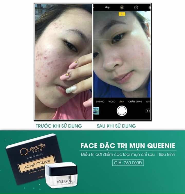 Bộ đôi kem xoá  mụn QUEENIE SKIN chín hãng siêu chất lượng hiệu quả ngay trong tuần sử dụng đầu tiên