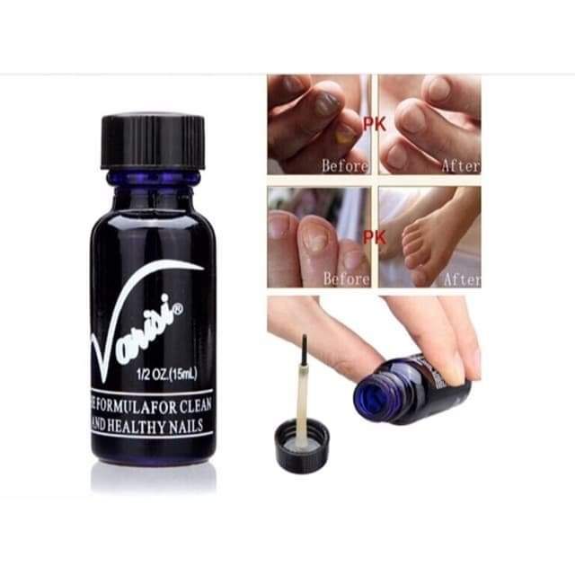 Nước nấm chân tay ngành nail