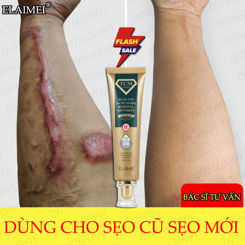 15 Loại bỏ sẹo*ELAIMEI Kem mờ sẹo 30g Thích hợp trị sẹo mổ sẹo mổ sau sinh  bỏng .V.V …Đã giải quyết dứt điểm sẹo của 2 triệu người (gel trị sẹo kem tẩy xóa sẹo kem trị sẹo lồi.Kem làm mờ sẹo)
