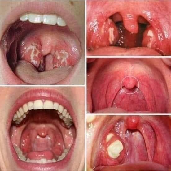 Hết Viêm Họng Amidan Sau 5 - 15 Ngày