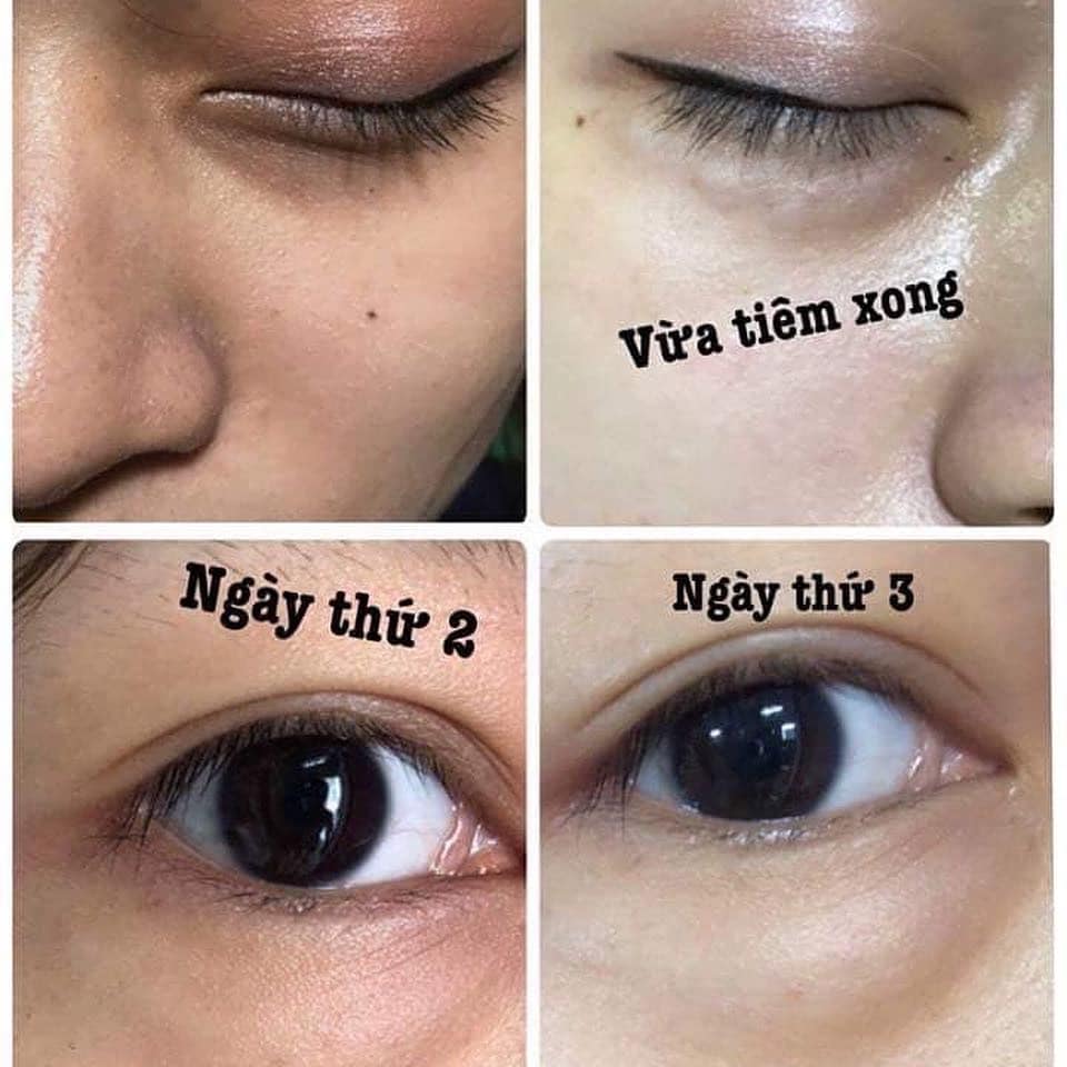 Tan quầng thâm mắt Eve Eyes - 1 hộp 1cc - Filler mắt