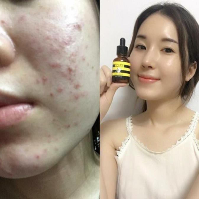 Serum Trị Mụn Kosxu Hàn Quốc 30Ml Chất Lượng Đảm Bảo An Toàn Đến Sức Khỏe Người Sử Dụng Cam Kết Hàng Đúng Mô Tả