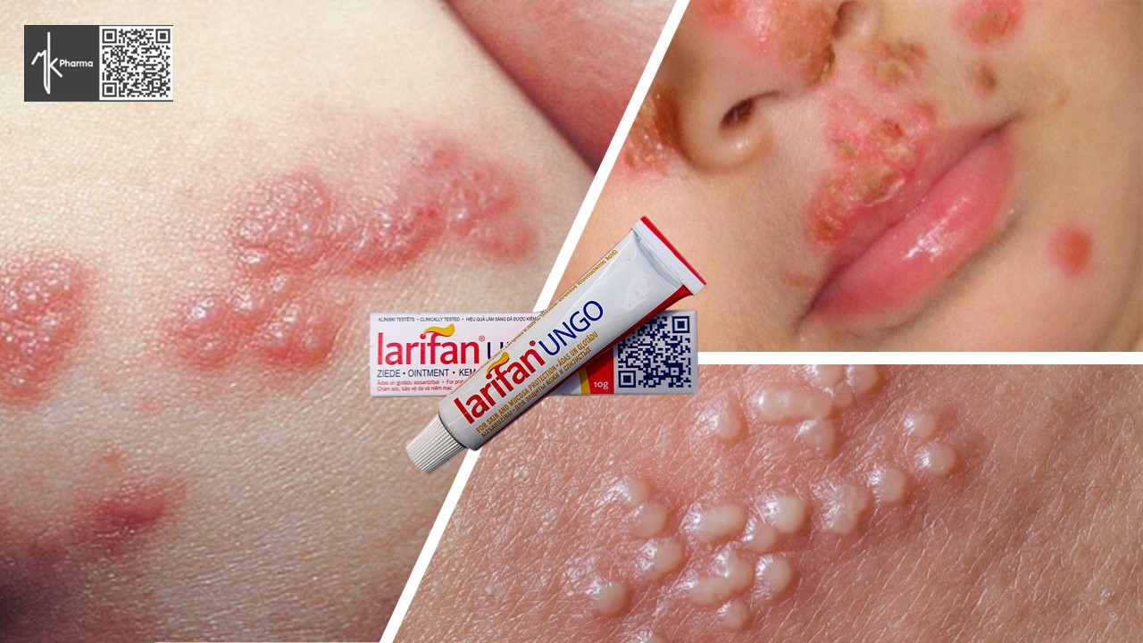 [Hcm]Herpes - Mụn Rộp Tái Phát Nhiều Lần Không Còn Là Nỗi Lo Khi Có Kem Bôi Larifan Ungo Từ Châu Âu