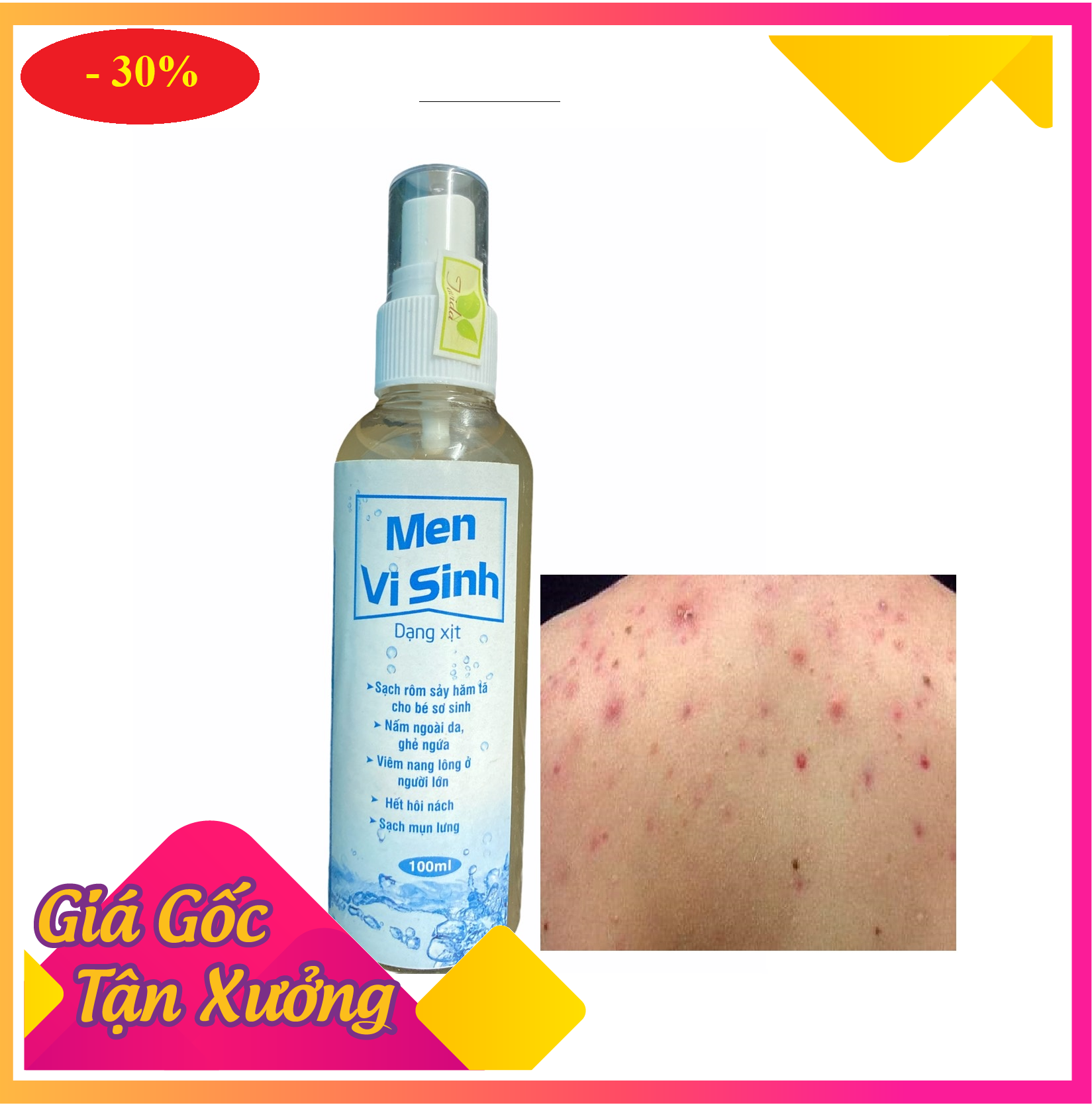 Xịt Men Vi Sinh ( Serum Trái Cây Lên Men ) Đánh Tan Nỗi Lô Mụn Lưng Ngực Viêm Nang Lông Nấm Da Mẩn Đỏ