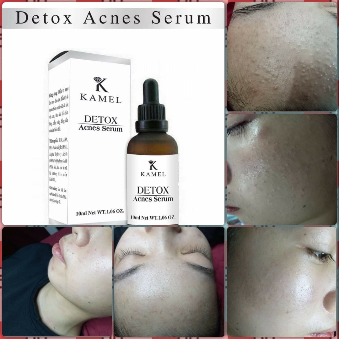 Cách Trị mụn SERUM TRỊ MỤN KAMEL DETOX ACNES giúp sạch hoàn toàn mụn trong 7 ngày