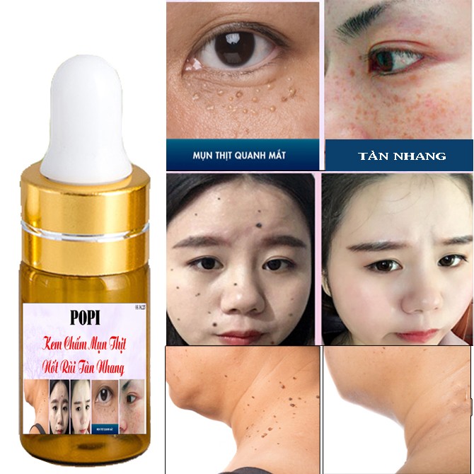 [HCM]KEM XÓA NỐT RUỒI TÀN NHANG ĐỒI MỒI. MỤN CÓC. MỤN THỊT  POPI
