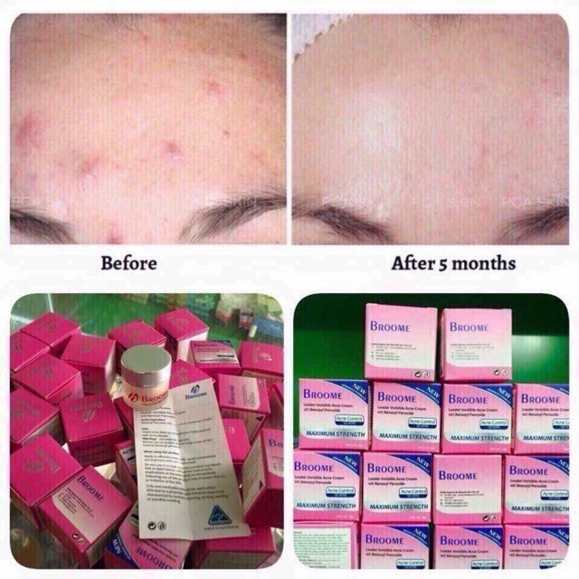 Kem Face Khử Mụn Broome Acnes 10G Khử Sạch Mụn Cám Mụn Bọc Mụn Đầu Đen Hiệu Quả