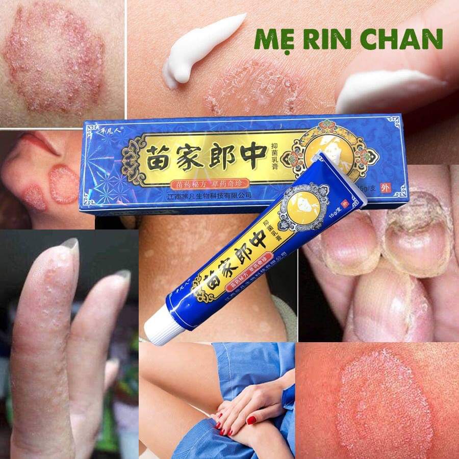 Kem Bôi Nấm Da Đầu Nấm Móng Chân Tay Hiệu Quả Hàng Nội Địa Trung Hoa