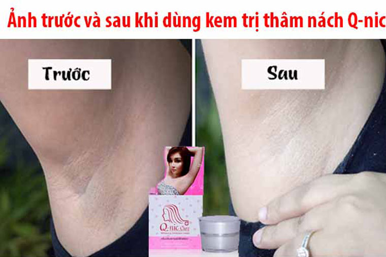 [Hcm]Kem Xóa Thâm Nách Mông Q Nic Care 15G Chính Hãng Thái Lan Hiệu Quả 7 Ngày