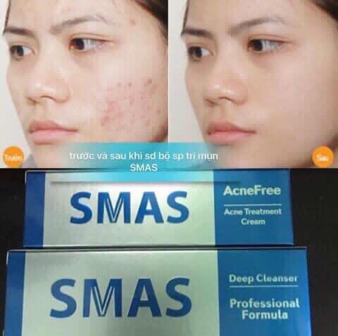 Kem Giảm Mụn Smas Acnefree