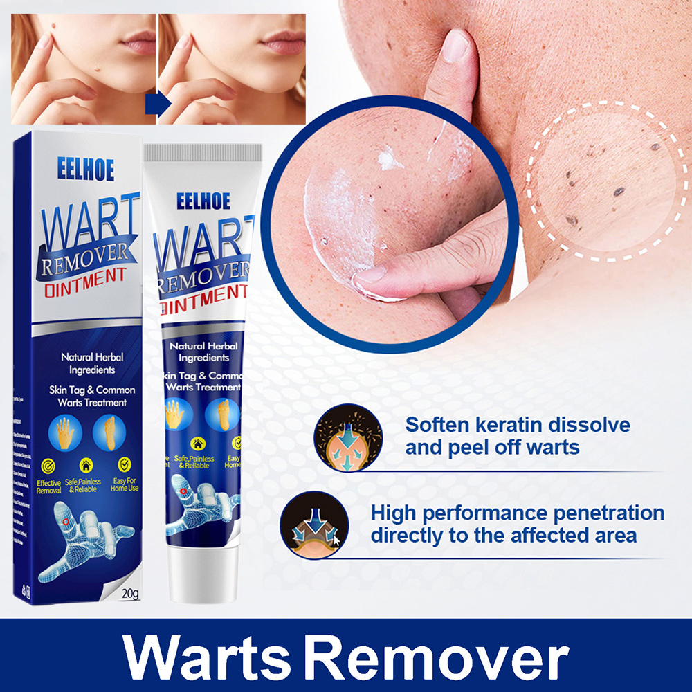 Warts Magic Remover Ointment Original Effectively Remove Common Warts Flat Warts Filamentous Warts And Sharp Warts 20g Painless ​Removal Skin Tag Warts Remover Mole And Warts Remover
