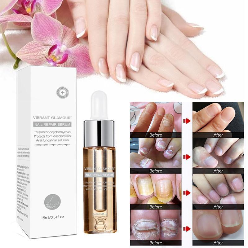 [Hcm]Nail Fungus Treatment Herb Nails Repair Cream Anti Infection Nail Foot Care Onychomycosis Removal Essence Nail Protector Serum